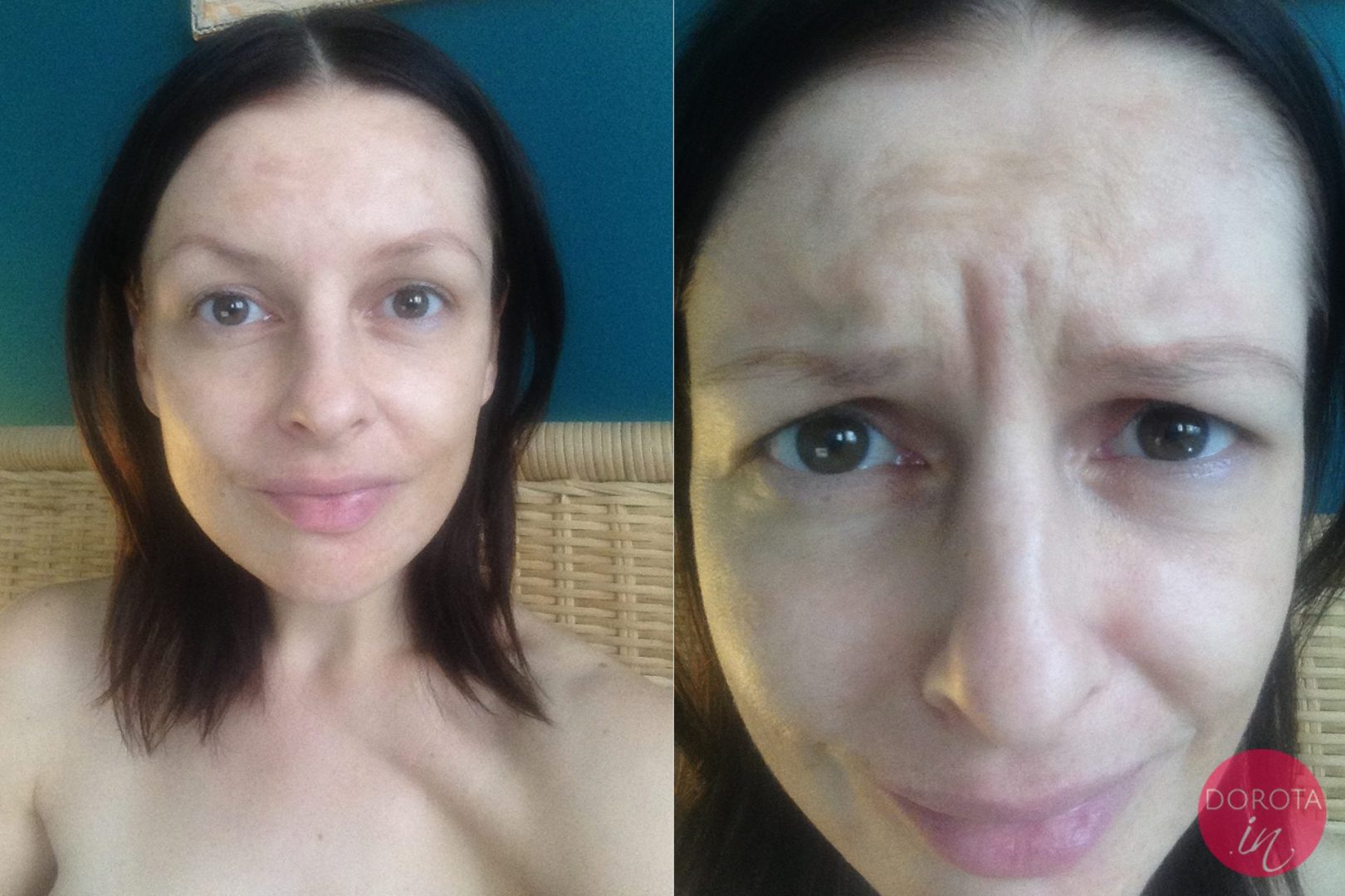 Kwas hialuronowy na zmarszczki - efekty | Dorota Kamińska