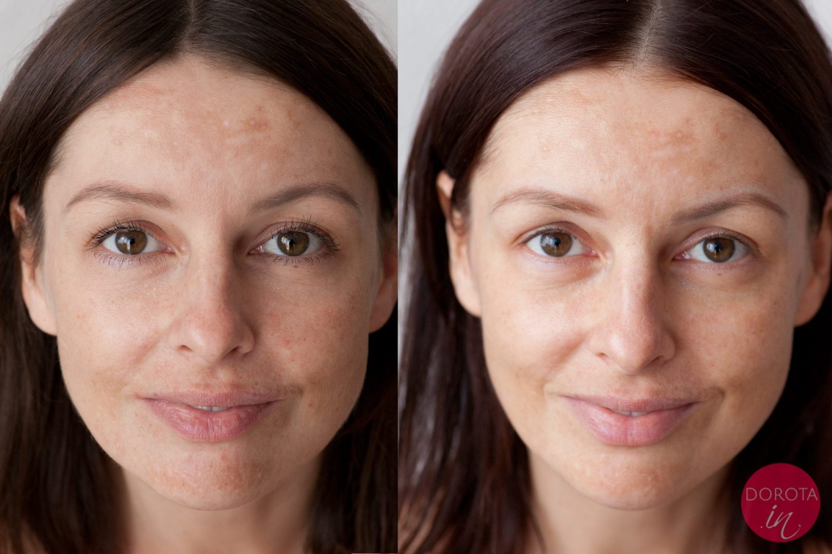 Kwas hialuronowy na zmarszczki - efekty | Dorota Kamińska
