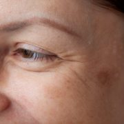 Dorota Kamińska - zmarszczki i kwas hialuronowy