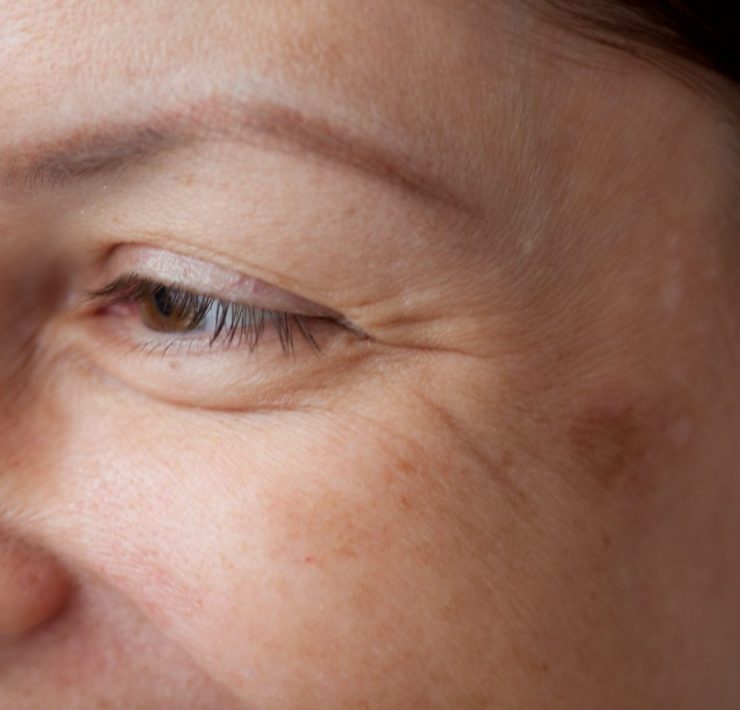 Dorota Kamińska - zmarszczki i kwas hialuronowy