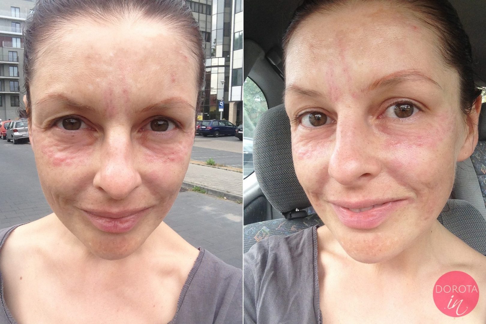 Kwas hialuronowy na zmarszczki - efekty | Dorota Kamińska