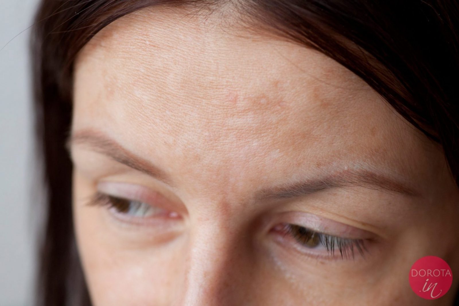Kwas hialuronowy na zmarszczki - efekty | Dorota Kamińska